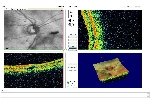 Moduł Jaskra: Skany tarczy nerwu wzrokowego w badaniu OCT JASKRA.
