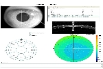 Moduł Przedni odcinek: Wykres końcowy badania OCT PACHYMETRIA.