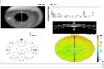 Moduł Przedni odcinek: Wykres końcowy badania OCT PACHYMETRIA.